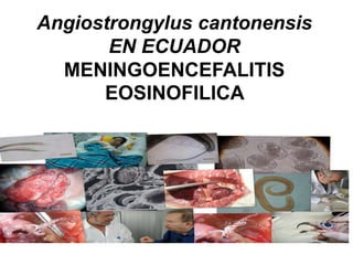 Angiostrongylus cantonensis
EN ECUADOR
MENINGOENCEFALITIS
EOSINOFILICA

 