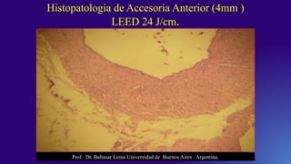 Histopatologia de Accesoria Anterior (4mm )
LEED 24 J/cm.
Prof. Dr. Baltasar Lema Universidad de Buenos Aires . Argentina.
 