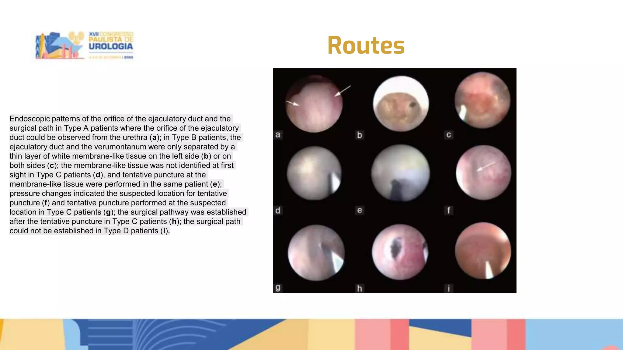 Transurethral seminal vesiculoscopy for chronic pelvic pain syndrome ...