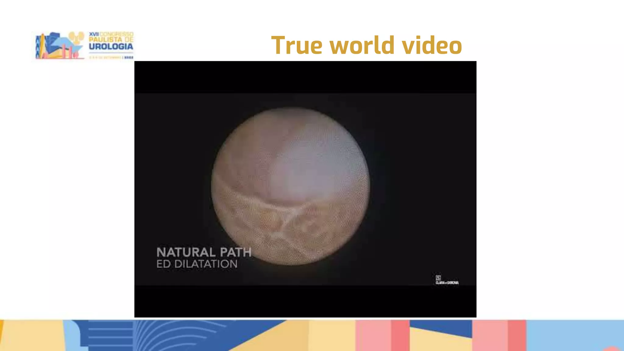 Transurethral seminal vesiculoscopy for chronic pelvic pain syndrome ...