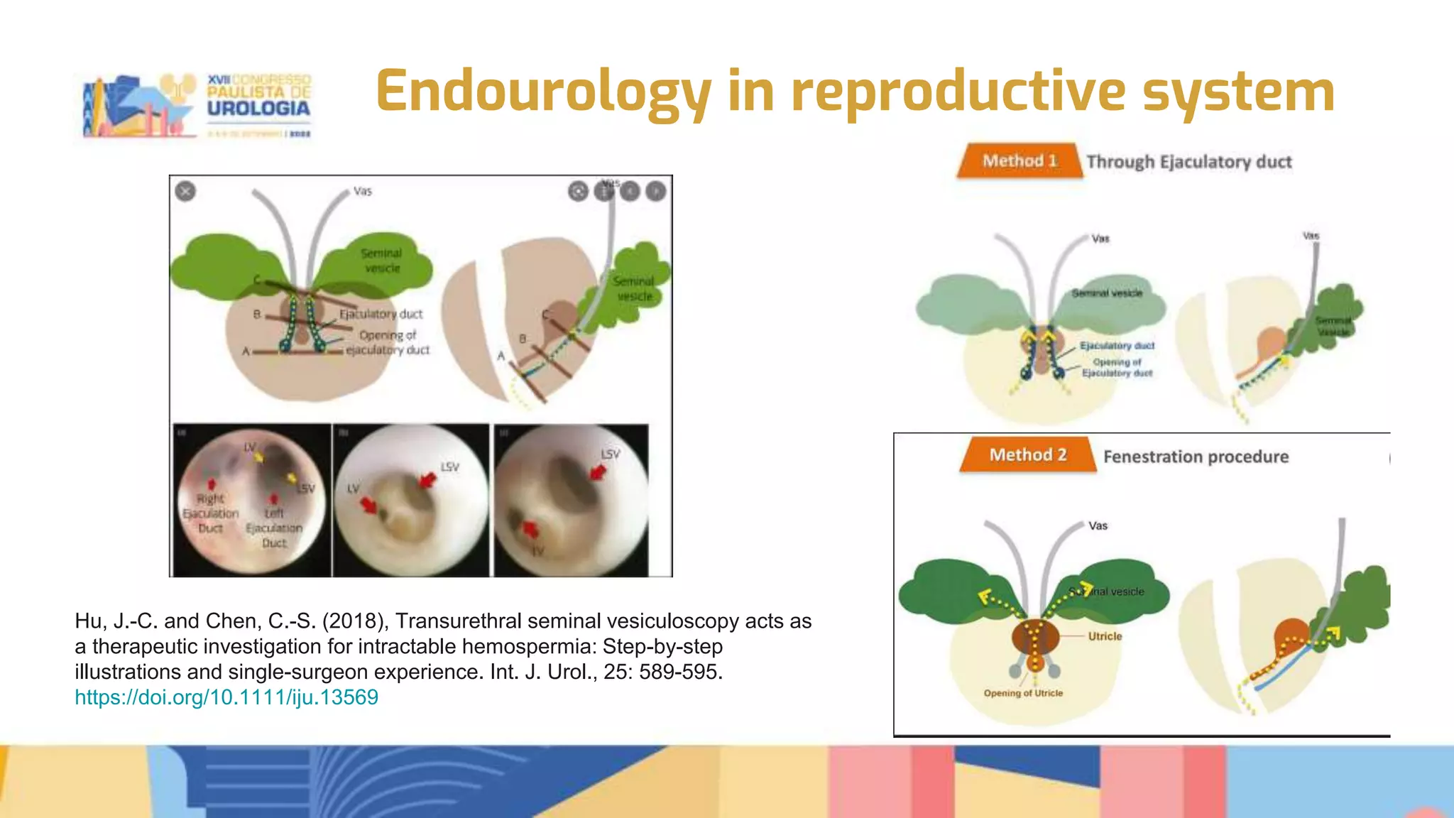 Transurethral seminal vesiculoscopy for chronic pelvic pain syndrome ...