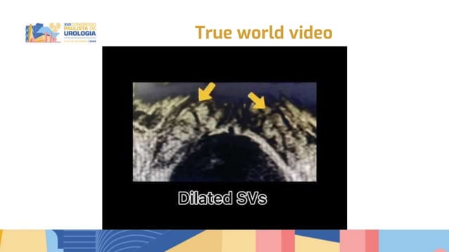 Transurethral seminal vesiculoscopy for chronic pelvic pain syndrome ...