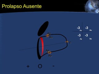 Prolapso Ausente Aa Ba C Bp Ap + O - Aa Ba Ap Bp -3 -3 -3 -3 