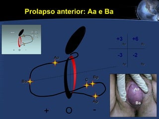 Prolapso anterior: Aa e Ba   Aa Ba C Bp Ap + O - Aa +3 Ba +6 Ap -3 Bp -2 Aa Ba 