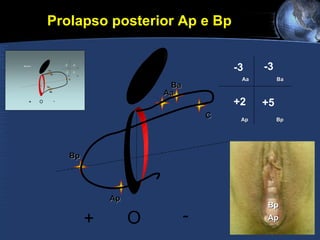 Aa Ba C Bp Ap Aa + O - Ba Ap Bp -3 -3 +2 +5 Prolapso posterior Ap e Bp  Ap Bp 