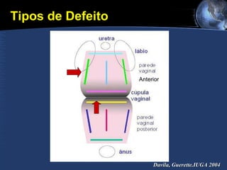 Davila, Guerette.IUGA 2004 Tipos de Defeito Anterior 