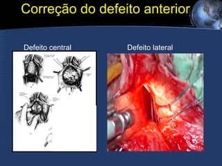 Correção do defeito anterior  Defeito central  Defeito lateral 