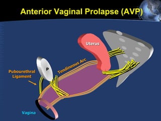 P Tendineous Arc Uterus Vagina Anterior Vaginal Prolapse (AVP) Pubourethral Ligament 