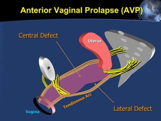 P Uterus Vagina Lateral Defect Anterior Vaginal Prolapse (AVP) Central Defect Tendineous Arc 