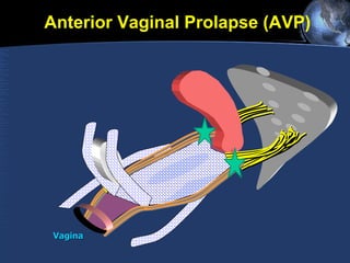 P Uterus Vagina Anterior Vaginal Prolapse (AVP) 