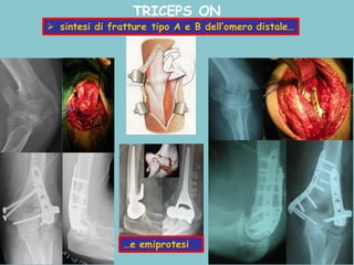TRICEPS ON
Ø sintesi di fratture tipo A e B dell’omero distale…
…e emiprotesi
 