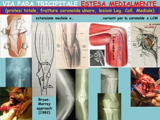 VIA PARA TRICIPITALE ESTESA MEDIALMENTE
estensione mediale e…
Bryan-
Morrey
approach
(1982)
(protesi totale, fratture coronoide ulnare, lesioni Leg. Coll. Mediale)
…varianti per la coronoide e LCM
 