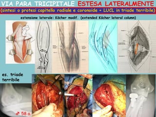 VIA PARA TRICIPITALE ESTESA LATERALMENTE
estensione laterale: Köcher modif. (extended Köcher lateral column)
(sintesi o protesi capitello radiale e coronoide + LUCL in triade terribile)
es. triade
terribile
♂ 58 a.
 