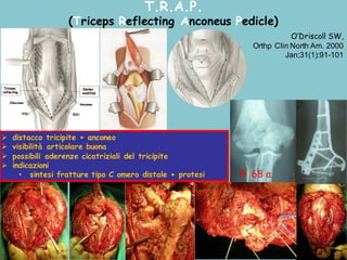 T.R.A.P.
(Triceps Reflecting Anconeus Pedicle)
Ø distacco tricipite + anconeo
Ø visibilità articolare buona
Ø possibili aderenze cicatriziali del tricipite
Ø indicazioni
• sintesi fratture tipo C omero distale + protesi
O’Driscoll SW,
Orthp Clin North Am. 2000
Jan;31(1):91-101
♀ 68 a.
 