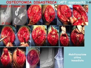 OSTEOTOMIA DIGASTRICA (AFT approach)
♂ 35 a.
Mobilizzazione
attiva
immediata
1-8
fratt. C3 omero sx
 