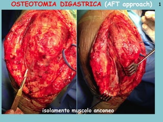OSTEOTOMIA DIGASTRICA (AFT approach) 1
isolamento muscolo anconeo
 