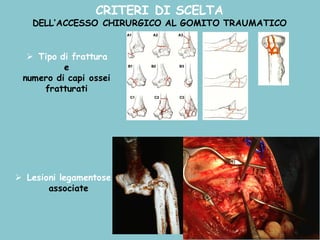 CRITERI DI SCELTA
DELL’ACCESSO CHIRURGICO AL GOMITO TRAUMATICO
Ø Tipo di frattura
e
numero di capi ossei
fratturati
Ø Lesioni legamentose
associate
 