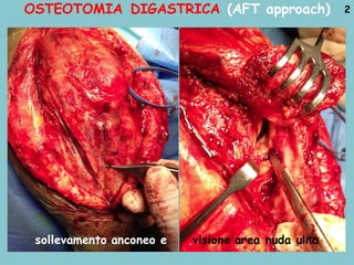 OSTEOTOMIA DIGASTRICA (AFT approach) 2
sollevamento anconeo e visione area nuda ulna
 