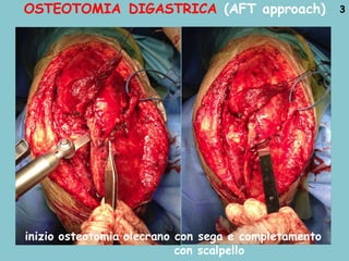 OSTEOTOMIA DIGASTRICA (AFT approach) 3
inizio osteotomia olecrano con sega e completamento
con scalpello
 