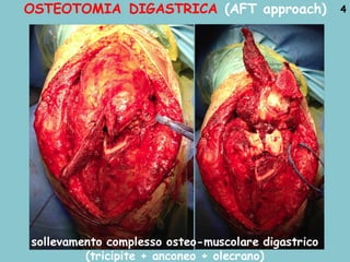 OSTEOTOMIA DIGASTRICA (AFT approach) 4
sollevamento complesso osteo-muscolare digastrico
(tricipite + anconeo + olecrano)
 