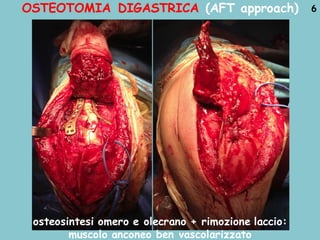 OSTEOTOMIA DIGASTRICA (AFT approach) 6
osteosintesi omero e olecrano + rimozione laccio:
muscolo anconeo ben vascolarizzato
 