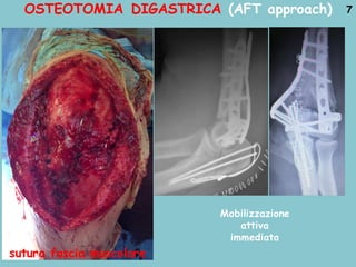 OSTEOTOMIA DIGASTRICA (AFT approach)
Mobilizzazione
attiva
immediata
7
sutura fascia muscolare
 