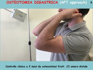 OSTEOTOMIA DIGASTRICA (AFT approach) 8
Controllo clinico a 2 mesi da osteosintesi fratt. C3 omero distale
 