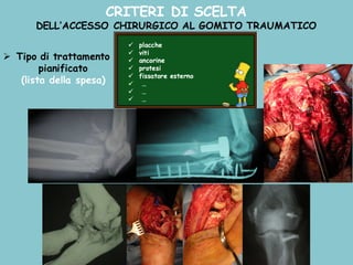CRITERI DI SCELTA
DELL’ACCESSO CHIRURGICO AL GOMITO TRAUMATICO
Ø Tipo di trattamento
pianificato
(lista della spesa)
 