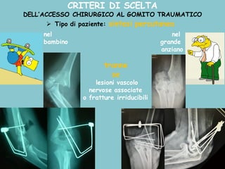 CRITERI DI SCELTA
DELL’ACCESSO CHIRURGICO AL GOMITO TRAUMATICO
Ø Tipo di paziente: sintesi percutanea
tranne
se
lesioni vascolo
nervose associate
o fratture irriducibili
nel
bambino
nel
grande
anziano
 