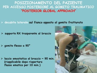 POSIZIONAMENTO DEL PAZIENTE
PER ACCESSO POSTERIORE AL GOMITO TRAUMATICO
“POSTERIOR GLOBAL APPROACH”
Ø decubito laterale sul fianco opposto al gomito fratturato
Ø supporto RX trasparente al braccio
Ø gomito flesso a 90°
Ø laccio emostatico al braccio ~ 90 min.
(riapplicabile dopo riapertura
flusso ematico per 10 min.)
 