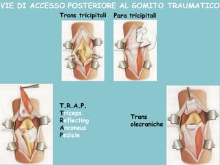 VIE DI ACCESSO POSTERIORE AL GOMITO TRAUMATICO
Trans tricipitali Para tricipitali
Trans
olecraniche
T.R.A.P.
Triceps
Reflecting
Anconeus
Pedicle
 