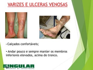 VARIZES E ULCERAS VENOSAS
• Calçados confortáveis;
• Andar pouco e sempre manter os membros
inferiores elevados, acima do tronco.
 