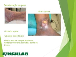 Ulcera venosa
• Hidratar a pele
•Calçados confortáveis;
• Andar pouco e sempre manter os
membros inferiores elevados, acima do
tronco.
Desidratação da pele
 