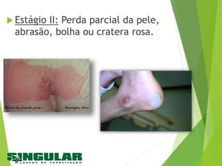  Estágio II: Perda parcial da pele,
abrasão, bolha ou cratera rosa.
 