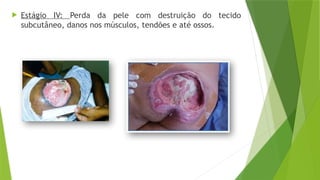  Estágio IV: Perda da pele com destruição do tecido
subcutâneo, danos nos músculos, tendões e até ossos.
 
