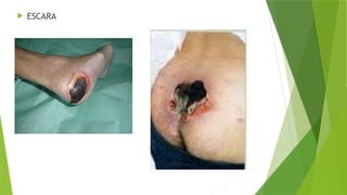 ESCARA
 