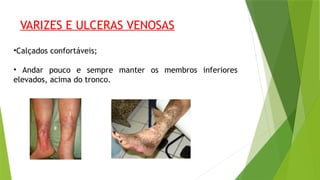 VARIZES E ULCERAS VENOSAS
•Calçados confortáveis;
• Andar pouco e sempre manter os membros inferiores
elevados, acima do tronco.
 