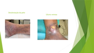 Desidratação da pele
Ulcera venosa
 