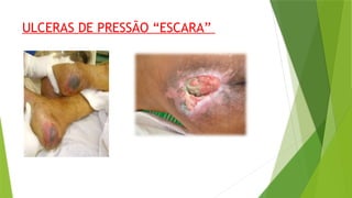 ULCERAS DE PRESSÃO “ESCARA”
 