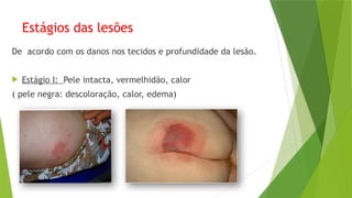 Estágios das lesões
De acordo com os danos nos tecidos e profundidade da lesão.
 Estágio I: Pele intacta, vermelhidão, calor
( pele negra: descoloração, calor, edema)
 