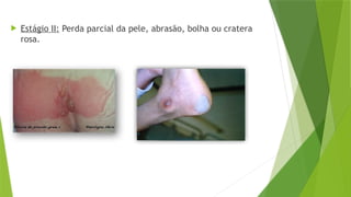  Estágio II: Perda parcial da pele, abrasão, bolha ou cratera
rosa.
 