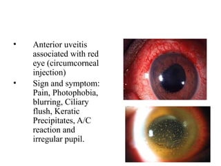 Pupil Injection Conjunctival and corneal injuries are most common ophthalmologic issues ...