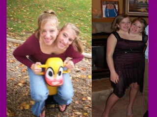 Conjoined Twins | PPT