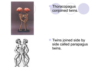 Conjoined twins | PPT