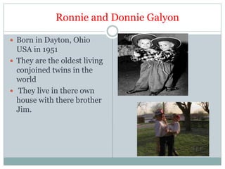 Well KnownConjoined TwinsChang and Eng Bunker Born 1811 died 1874Thai brothers born in Siam. They were joined at the sternum by a small piece of cartilage.Both married and had 21 children between them.Chang died of pneumonia  but Eng refused to be separated and died three hours later.  