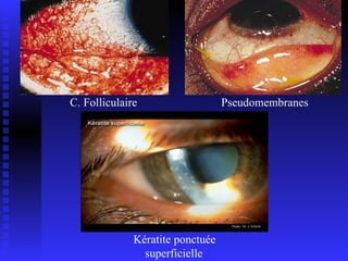 C. Folliculaire Pseudomembranes Kératite ponctuée superficielle