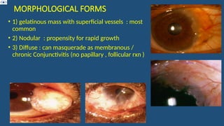MORPHOLOGICAL FORMS
• 1) gelatinous mass with superficial vessels : most
common
• 2) Nodular : propensity for rapid growth
• 3) Diffuse : can masquerade as membranous /
chronic Conjunctivitis (no papillary , follicular rxn )
 