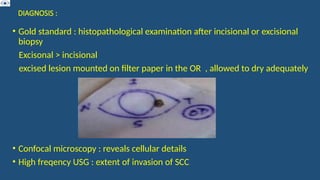 DIAGNOSIS :
• Gold standard : histopathological examination after incisional or excisional
biopsy
Excisonal > incisional
excised lesion mounted on filter paper in the OR , allowed to dry adequately
• Confocal microscopy : reveals cellular details
• High freqency USG : extent of invasion of SCC
 