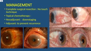 MANAGEMENT
• Complete surgical resection : No touch
technique
• Topical chemotherapy :
• Neoadjuvant : downstaging
• Adjuvant: to prevent recurrence
 