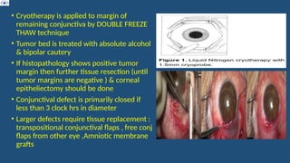 • Cryotherapy is applied to margin of
remaining conjunctiva by DOUBLE FREEZE
THAW technique
• Tumor bed is treated with absolute alcohol
& bipolar cautery
• If histopathology shows positive tumor
margin then further tissue resection (until
tumor margins are negative ) & corneal
epitheliectomy should be done
• Conjunctival defect is primarily closed if
less than 3 clock hrs in diameter
• Larger defects require tissue replacement :
transpositional conjunctival flaps , free conj
flaps from other eye ,Amniotic membrane
grafts
 